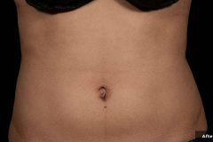 trusculptflex-Stephen-Ronan-MD-P3-8w-after-6txs