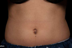 trusculptflex-Stephen-Ronan-MD-P3-before