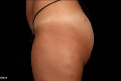 trusculptflex-Stephen-Ronan-MD-P4-rightsidebutt-before