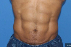 trusculptflex-michael-somenek-MD-P1-12w-after-4txs