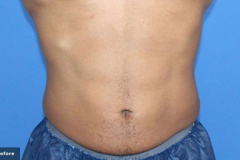 trusculptflex-michael-somenek-MD-P1-before